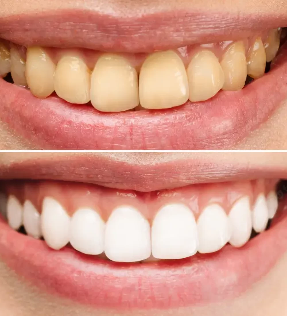 Clareamento dental Brasília